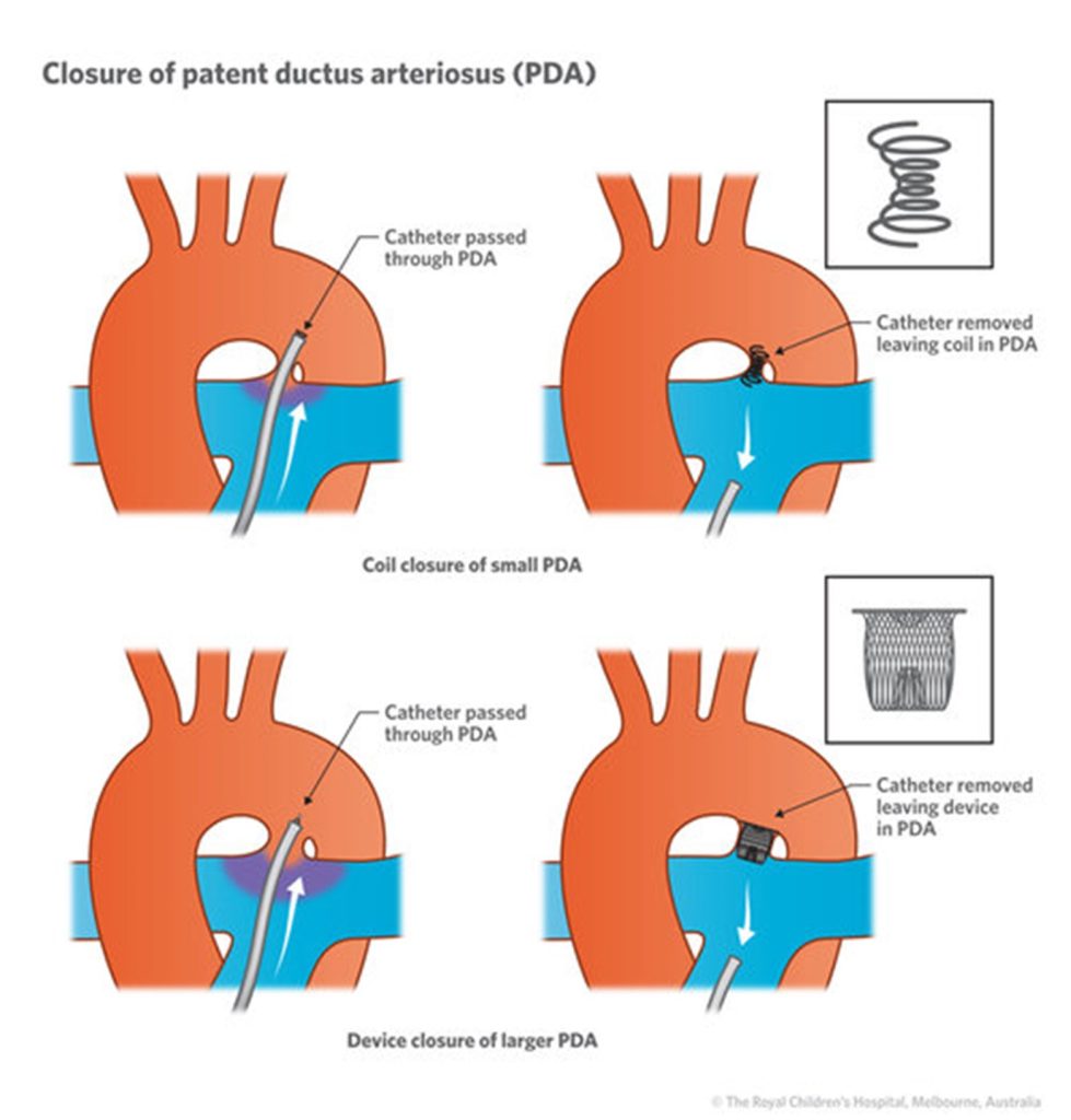 pda-closure