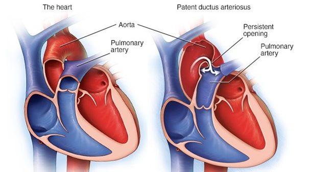 pda-heart