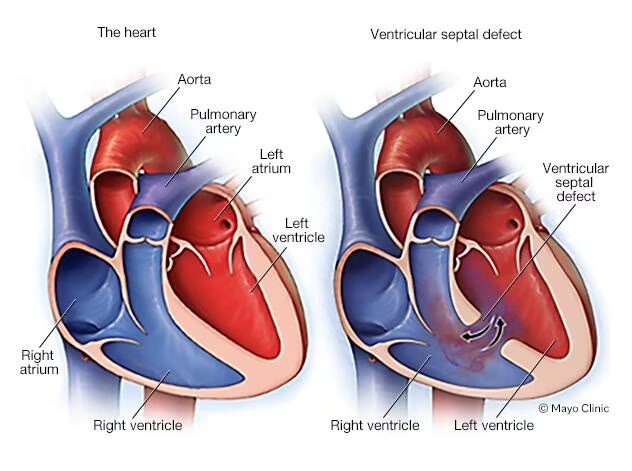 ventriküler septal defekt